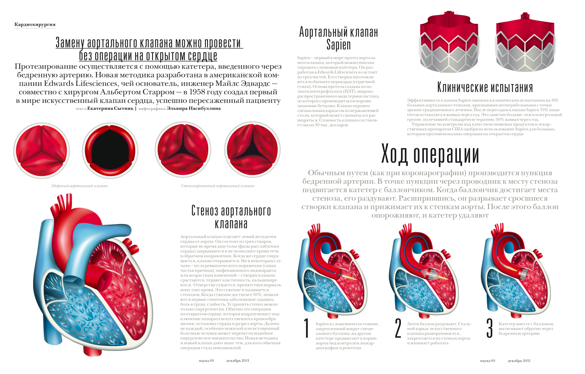 Аортальный клапан сердца операция