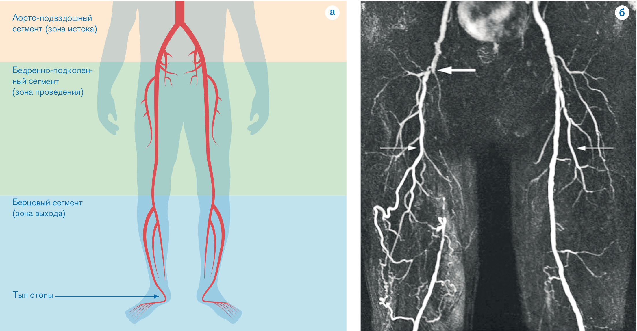 рис.02 Проявления заболеваний периферических артерий в результате атеросклеротической окклюзии крупных артерий нижних конечностей