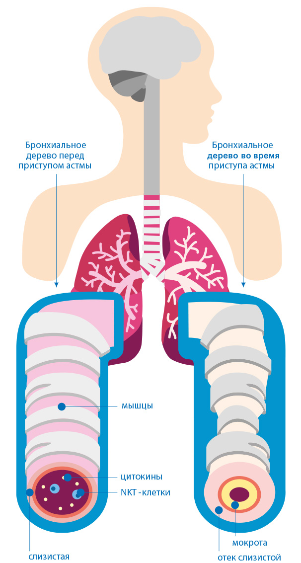Bronchial asthma. Бронхиальная астма. Бронхиальная астма легкие. Бронхи при бронхиальной астме.