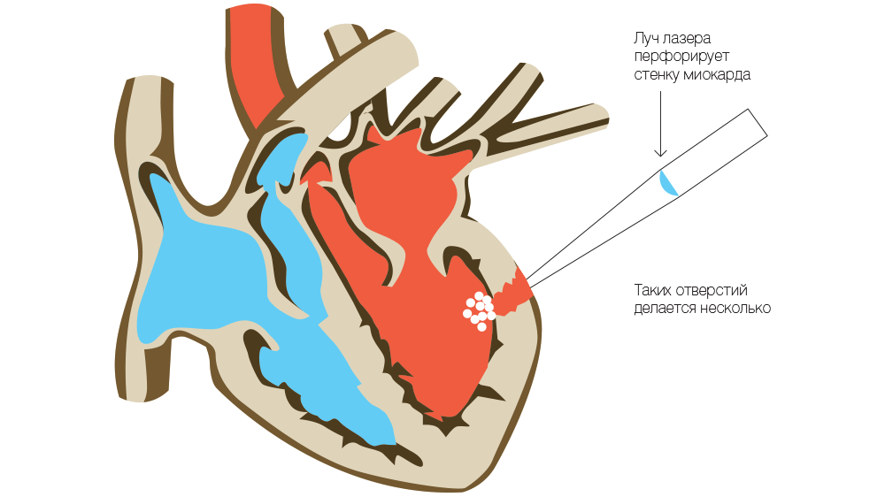 Схема процедуры трансмиокардиальной лазерной реваскуляризации миокарда 
