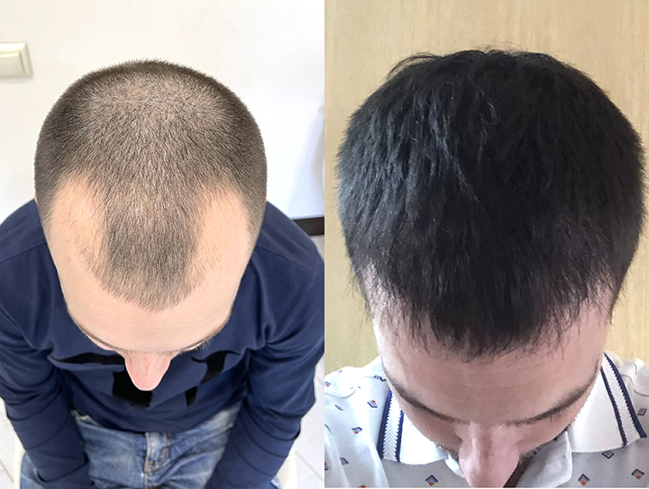 До и после процедуры пересадки волос, медицинский центр «Витанова»