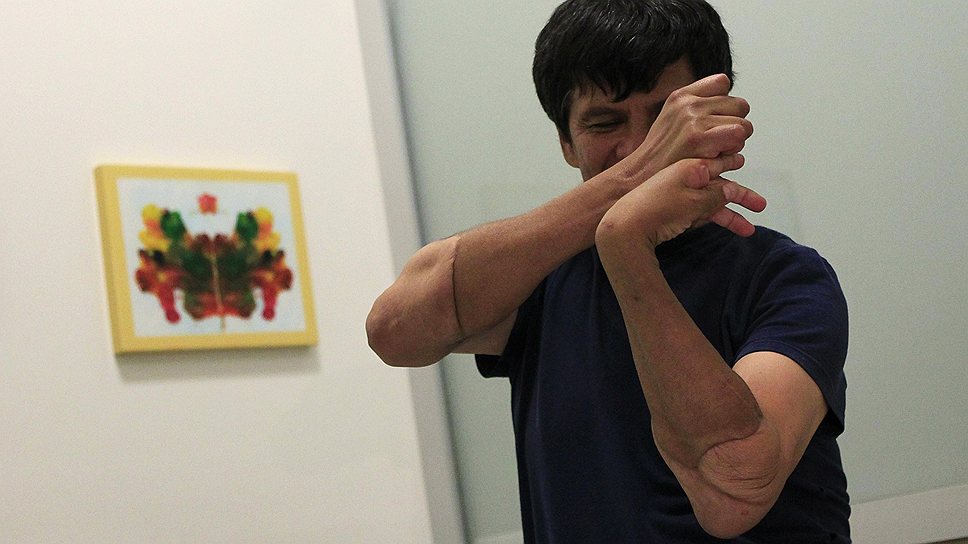 Габриэль Гранадос ждет физиотерапию в Мехико спустя два года после тяжелых ожогов на руках, пересадки предплечья и установки протезов 