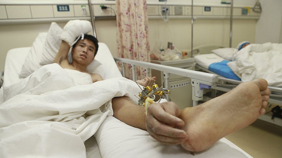 Китайский рабочий, потерявший руку из-за несчастного случая на производстве, перед реплантацией. Врачи больницы при Центральном южном университете в Чанше были вынуждены на месяц приживить кисть к его ноге, чтобы сохранить ее для операции