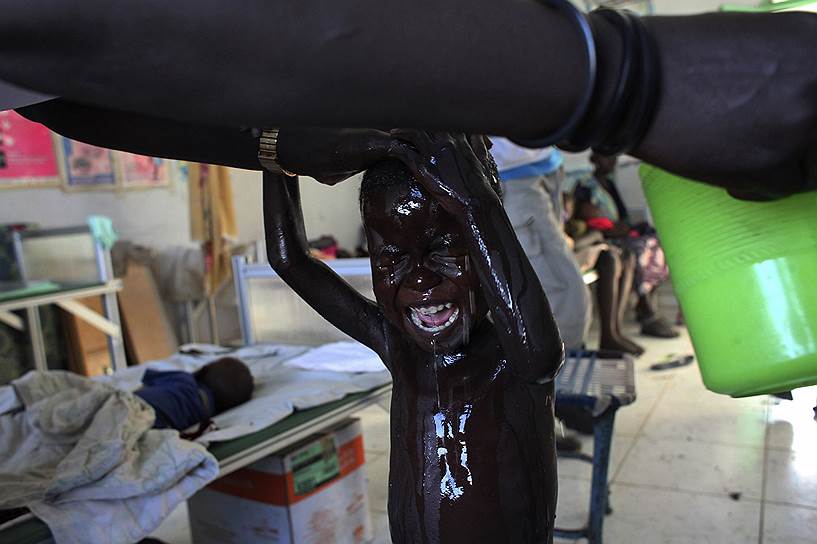 Юный южносуданский беженец, страдающий от недоедания, в центре кормления «Врачей без границ» в Кодоке