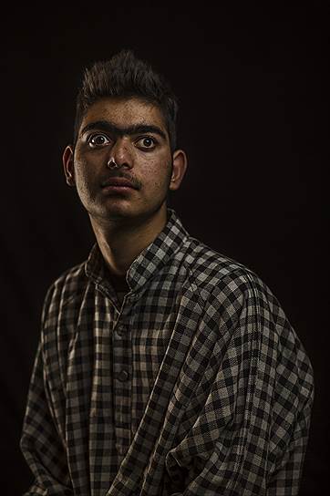 «Моя жизнь разрушена. Что я теперь?»&lt;br>Сухаил Ахмад Мир был ранен металлическими осколками. Его левый глаз полностью не видит, а на лице остались шрамы