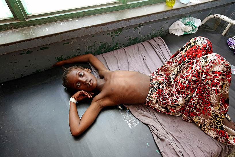 Могадишо, Сомали. Больная диареей девочка в госпитале после того, как ее вывезли из лагеря для беженцев
