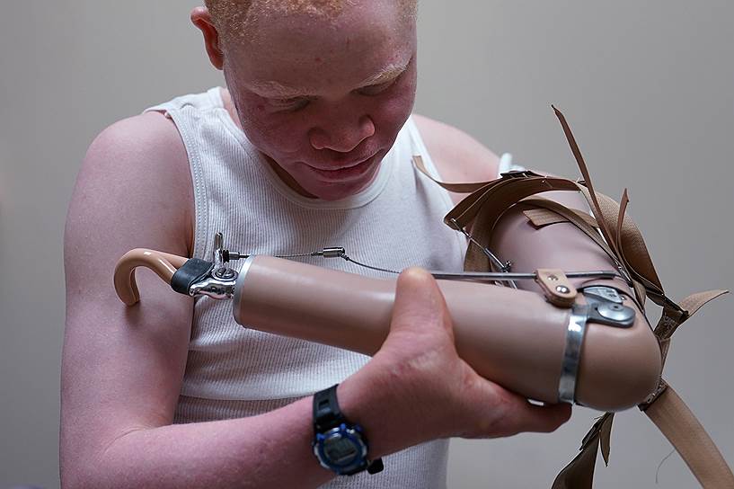 Филадельфия, США. Танзаниец-альбинос Эммануэль Рутема примеряет протез на руку, отрубленную во время нападения на него