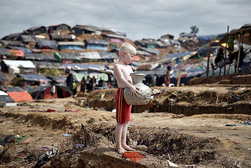 Кокс-Базар, Бангладеш. Мальчик-альбинос в лагере беженцев-рохинджа 