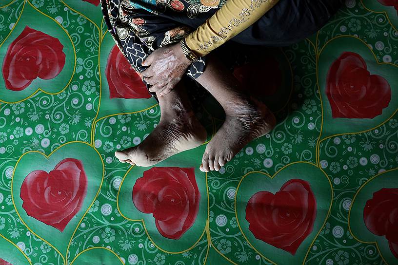 Текнаф, Бангладеш. Беженка-рохинджа, ставшая жертвой изнасилования, показывает шрамы 