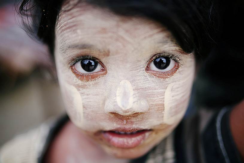 Кокс-Базар, Бангладеш. Ребенок беженцев-рохинджа с нанесенным на лицо кремом 