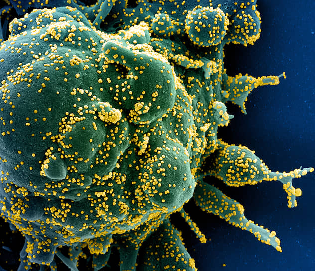 Клетка, инфицированная вирусом SARS-CoV-2, вызывающим заболевание COVID-19