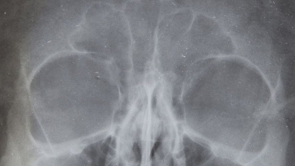 Рентгеновские снимки и врачебная документация по пластическим операциям, сделанным Мэрилин Монро. Исключительно подбородок и нос. $25 600 
