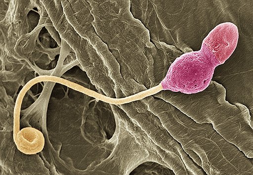 На каждый российский сперматозоид приходится несколько тысяч молекул диоксина. В сперме есть также фталаты, свинец, кадмий. На верхнем фото (поврежденный сперматозоид) видно, к каким последствиям это приводит. Таких, как внизу, остается все меньше. Снимки сделаны на сканирующем электронном микроскопе 