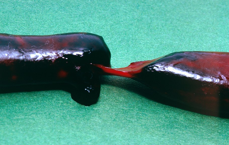 Крупный тромб, возникший при тромбозе глубоких вен