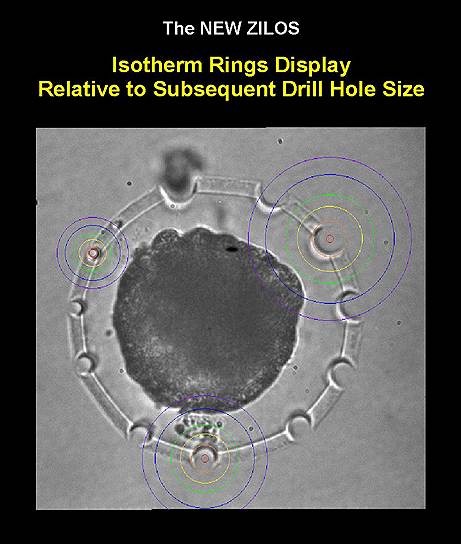 Микрофотография эмбриона после серии пробных лазерных воздействий. Мощность лазерного излучения не меняется, а регулировка энергии осуществляется длительностью лазерного импульса. Изотермы (по часовой стрелке) представлены для трех значений длительности импульсов: 5 мс, 3 мс и 1 мс. Цвет окружности-изотермы: фиолетовый -- 50 С, синий -- 60 С, зеленый -- 80 С, желтый -- 100 С. Оранжевая окружность обозначает размер формируемого отверстия в оболочке 
