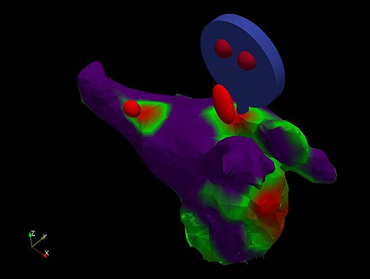 Левое предсердие. Левая боковая косая проекция. 3D-реконструкция изображений, полученных путем совмещения данных мультиспиральной компьютерной томографии сердца и I123-mIBG ОФЭКТ. Очаги накопления раидофармпрепарата, соответствующие анатомической локализации ганглионарных сплетений, отмечены красным цветом 
