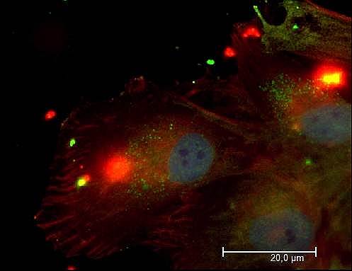 Клеточная культура глиомы, окрашенная флуоресцентными зелеными и красными антителами на факторы, важные для таргетной терапии. Синим цветом окрашено ядро клетки