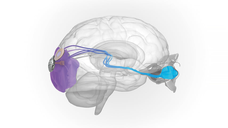 Имплант для вживления в кору головного мозга ELVIS