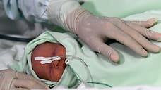Двух родившихся раньше срока детей с заболеваниями прооперировали в Удмуртии